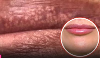 🚨Si notas estos pequeños granos en tus labios o zona íntima, tu cuerpo podría estar enviándote una señal importante que no deberías ignorar