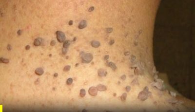 Pueden ser fibropapilomas… Revisa los comentarios 👇