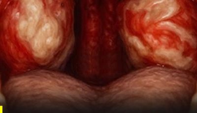 Un beso, un descuido… y listo. Así se transmite una de las infecciones más comunes entre jóvenes 😳