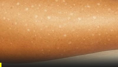 ¿Te han salido pequeñas manchas blancas en brazos o piernas… y no sabes qué son? A esto se debe según especialista👇